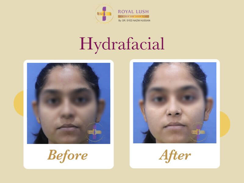 Hydra facial Before after treated by Dr Syed at Royal Lush CLinic in South Delhi